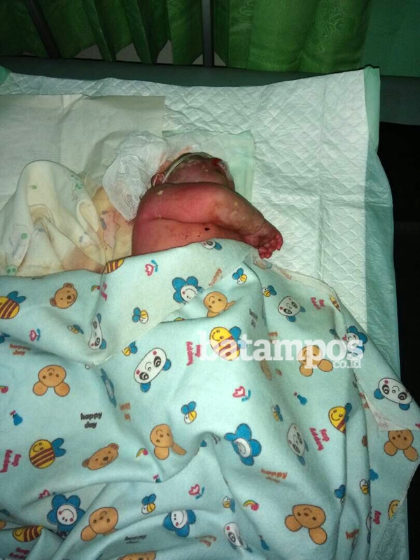 Bayi Tanpa Batok Kepala Lahir di RSUD Dabo