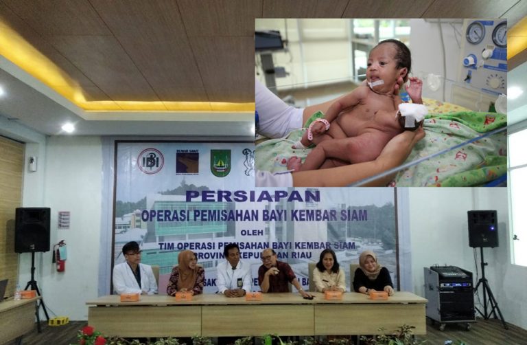 12 Jam untuk Pisahkan Bayi Kembar Siam di Batam