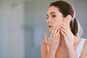 Atasi Jerawat dengan Acne Gel