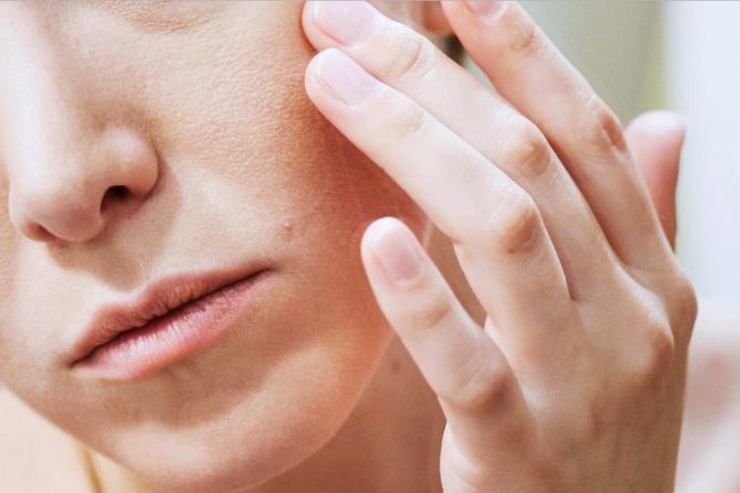 5 Langkah Penting Merawat Kulit Berjerawat