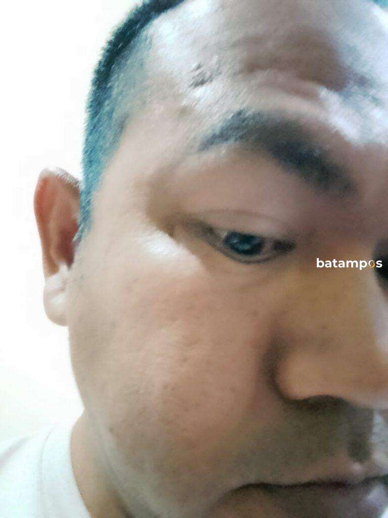 Warga Kawal, Bintan Jadi Korban Dugaan Pemukulan oleh Pengungsi asal Sudan