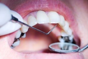 3 Tips Cegah Karang Gigi dan Penyakit Gusi