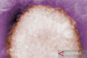 5 Infeksi Cacar Monyet Diidentifikasi oleh Portugal