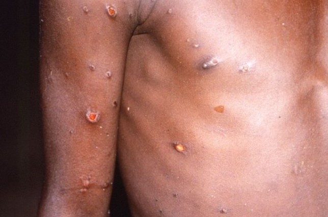 Kemenkes Waspada Monkey Pox