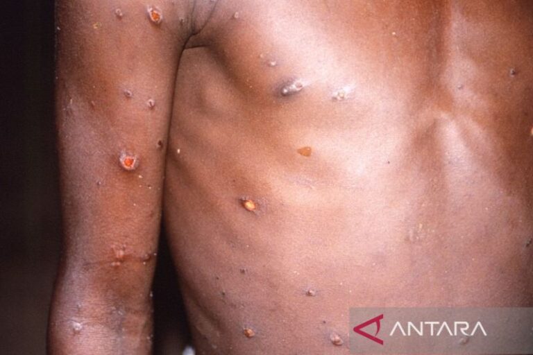 Ditemukan 2 Kasus Virus Cacar Monyet di Kanada