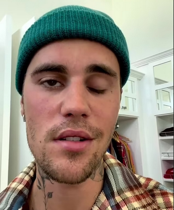 Justin Bieber Alami Lumpuh Wajah Akibat Sindrom Ramsay Hunt