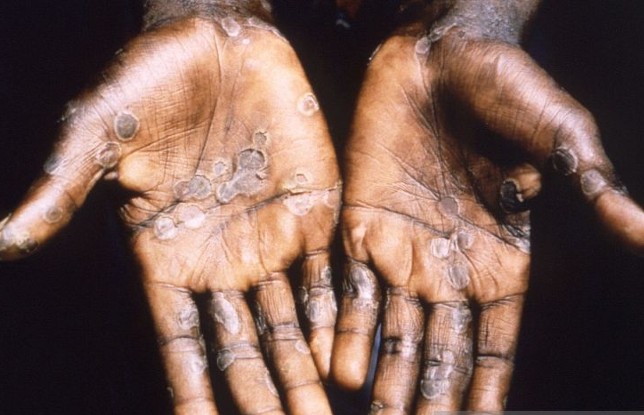 Sembilan Suspect Monkeypox Dinyatakan Negatif