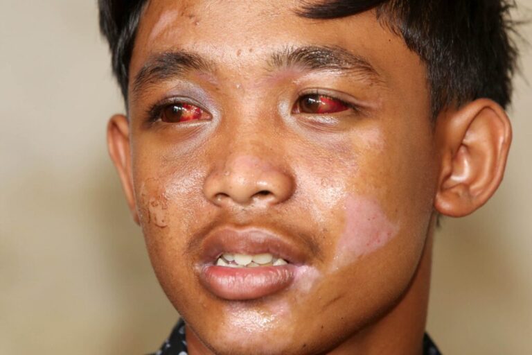 Komnas HAM Tegaskan Gas Air Mata Picu Banyak Korban Tragedi Kanjuruhan