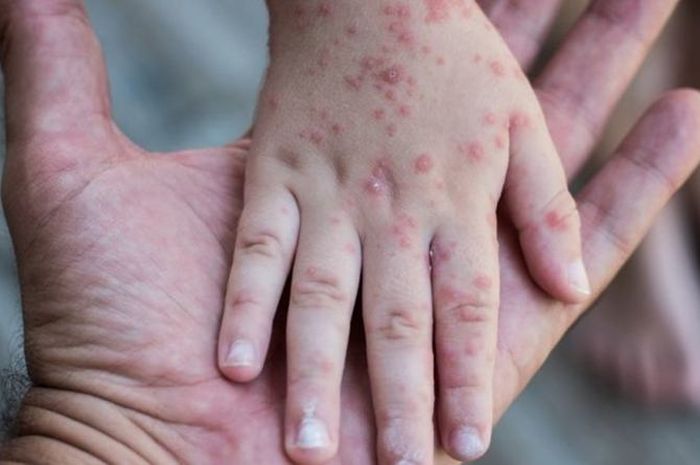 Gejala dan Penanganan Flu Singapura, Salah Satunya Makan Es Krim