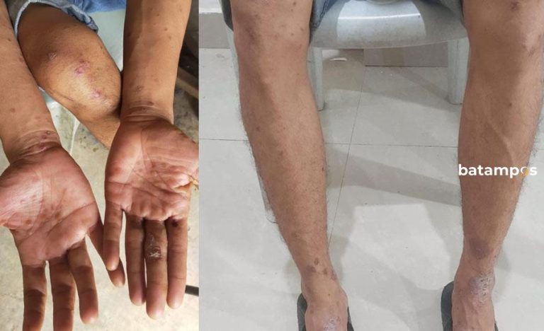 Dua Warga Batam Kontak Erat Pasien Cacar Monyet, Ini Hasil Tesnya