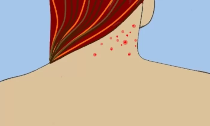 Tips Atasi Jerawat yang Muncul di Leher