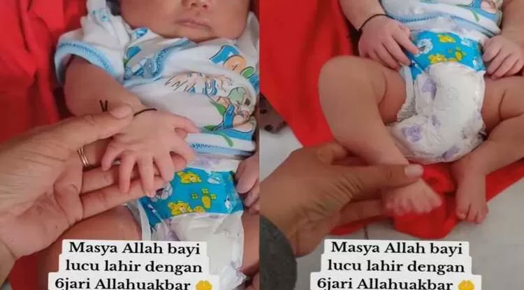 Bayi Terlahir dengan 6 Jari
