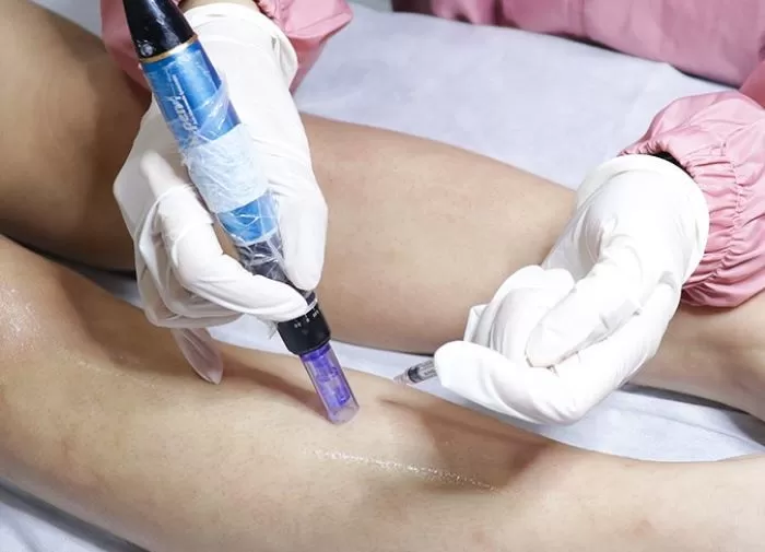 Simak 5 Cara Menghilangkan Bekas Luka Membandel