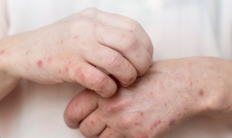 Kusta Jadi Momok Abadi Indonesia