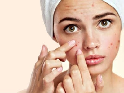 Ini 7 Cara Merawat Kulit Berjerawat yang Bisa Dicoba