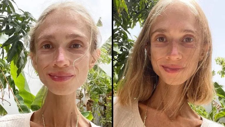 Wanita Polandia Tewas di Bali Setelah Diet Buah Ekstrem, Berat Badan Turun Jadi 22 Kg