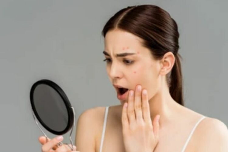 Minuman Pagi Ini Hilangkan Jerawat dalam 7 Hari, Berikut Cara Buatnya